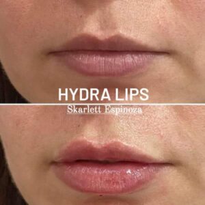 HYDRA-LIPS (Tratamiento dermapen/hidratación de labios + semi pigmento)