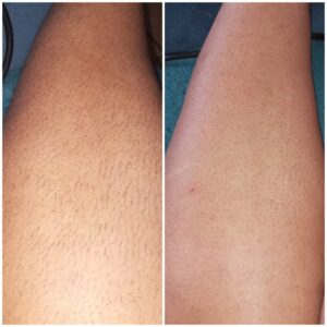 DEPILACION C/CERA ROLL-ON (media pierna)