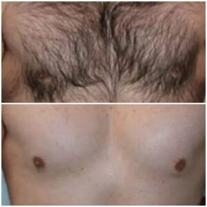 DEPILACION C/CERA ELASTICADA O ROLL-ON(torso completo)