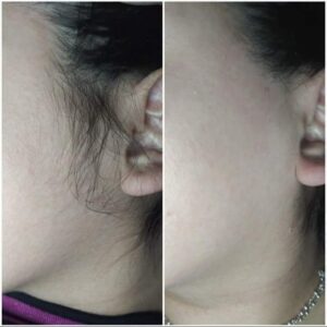 DEPILACION C/CERA (barba/ bozo + mentón + patilla)